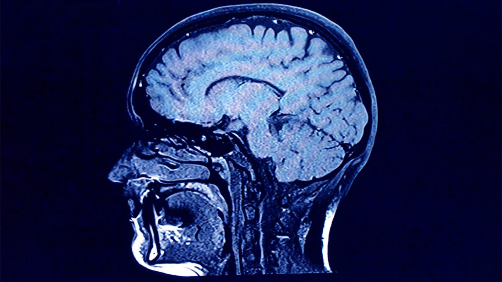 Effect of COVID-19 on The Brain